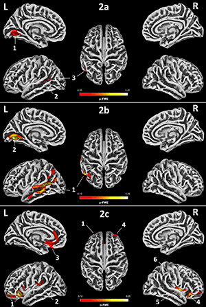Three-dimensional maps showing correlations between The Reading House total scores and gray matter cortical thickness 